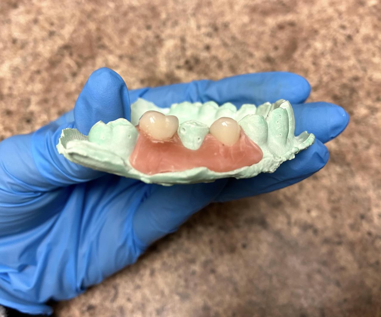 Diy partial denture kit